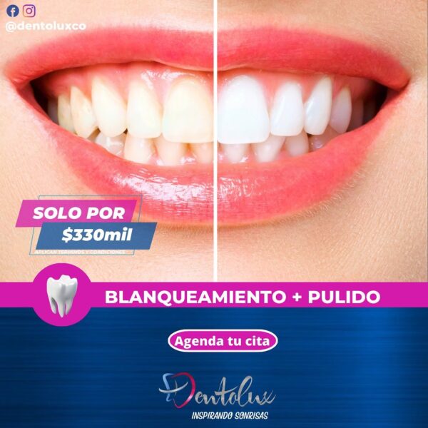 Blanqueamiento